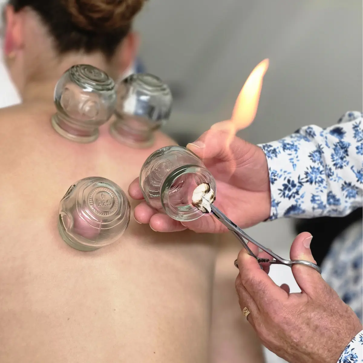 Cupping