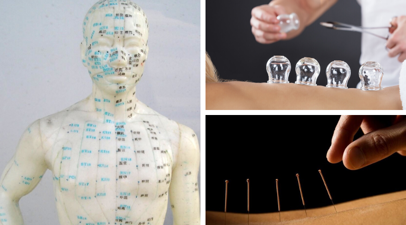 Dry Needling is Not Acupuncture
